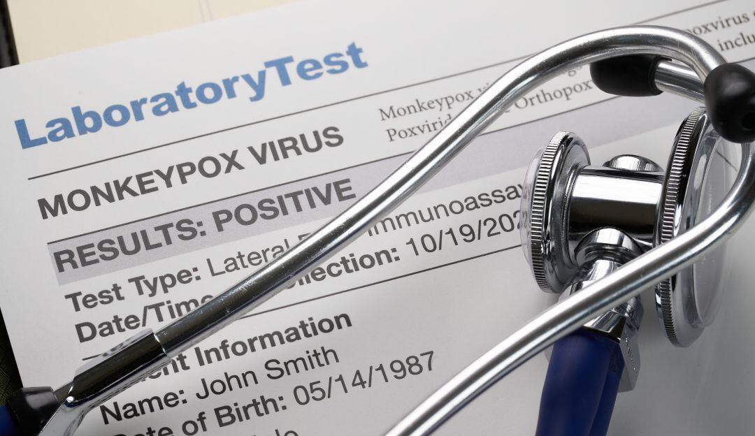 EE.UU. usará vacuna de la viruela común para prevenir la viruela del mono