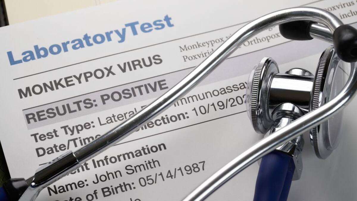 EE.UU. usará vacuna de la viruela común para prevenir la viruela del mono