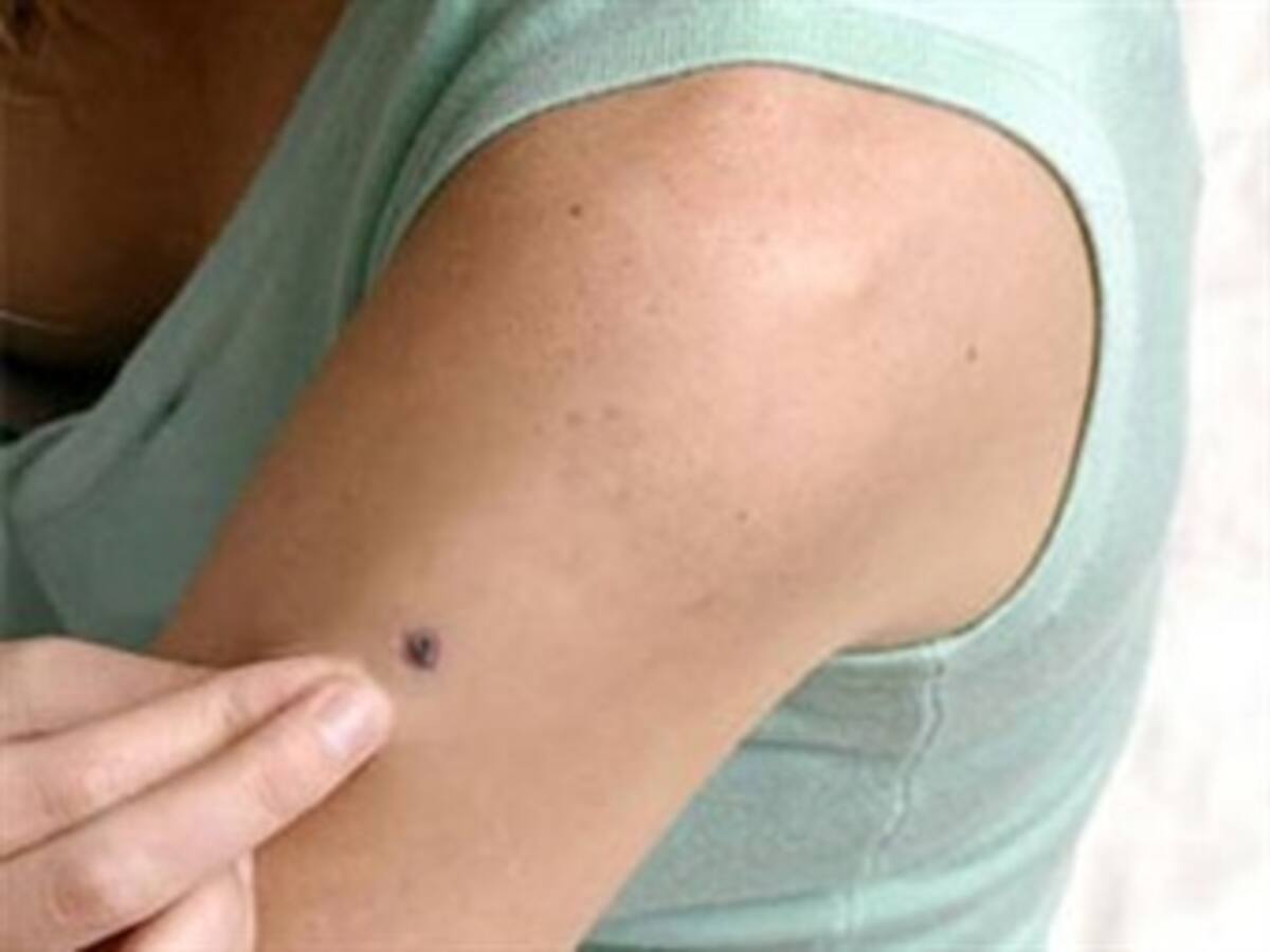 Lunares peligrosos que pueden llevar al cáncer: Luis Hernando Moreno, médico dermatólogo