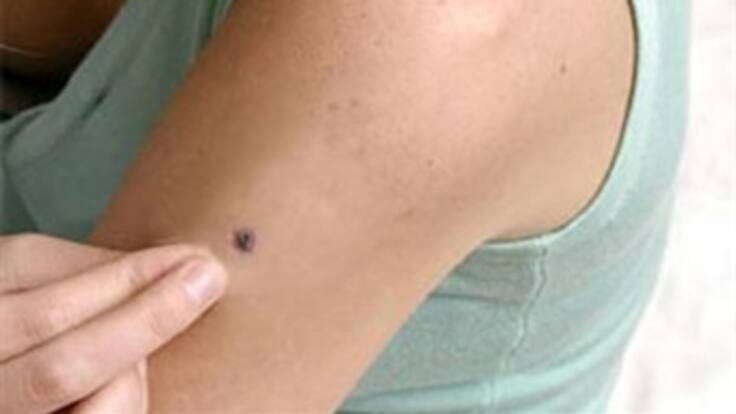 Lunares peligrosos que pueden llevar al cáncer: Luis Hernando Moreno, médico dermatólogo
