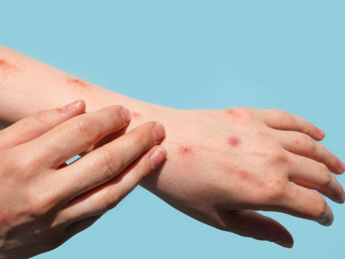 Viruela del mono y los síntomas importantes a tener en cuenta