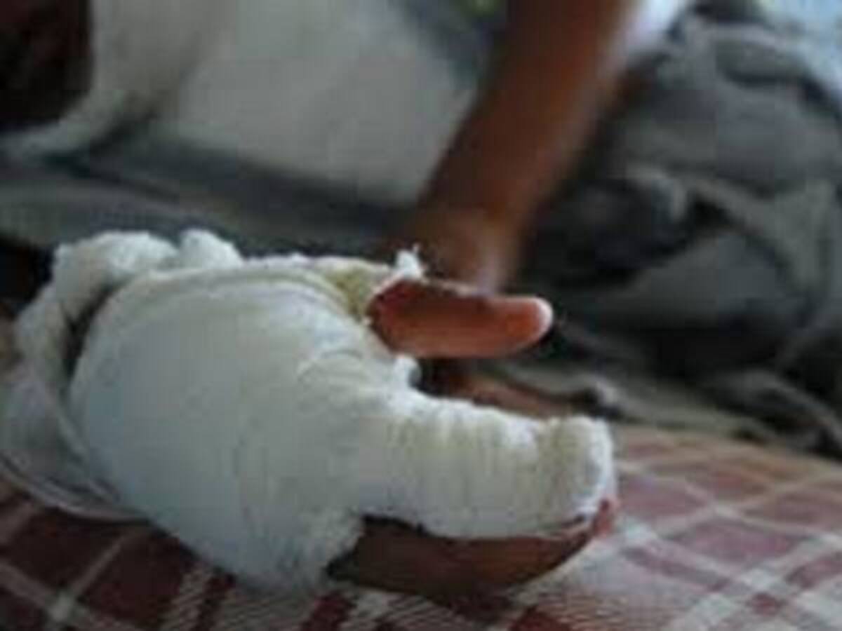 En accidente casero menor resultó quemado en Huila