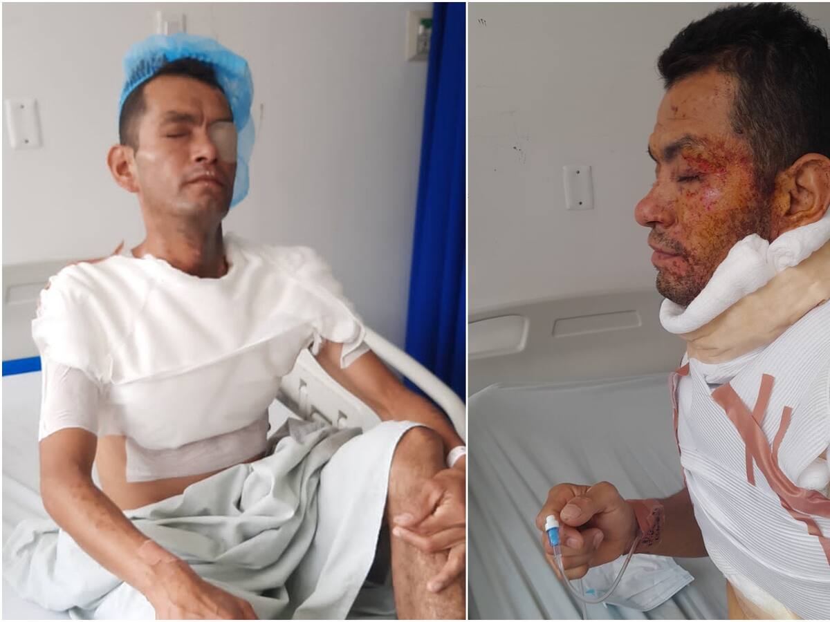 Un hombre fue quemado con ácido por una mujer en Ibagué