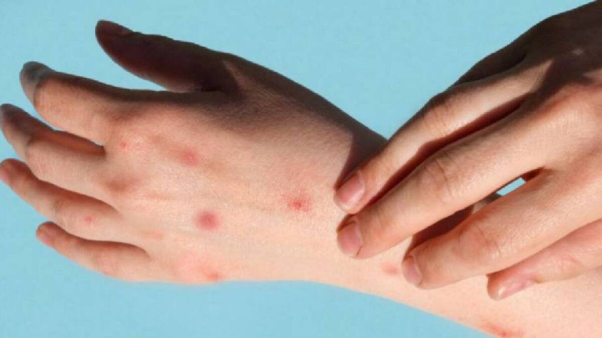 Confirman segundo casos de la viruela del mono en Quindío