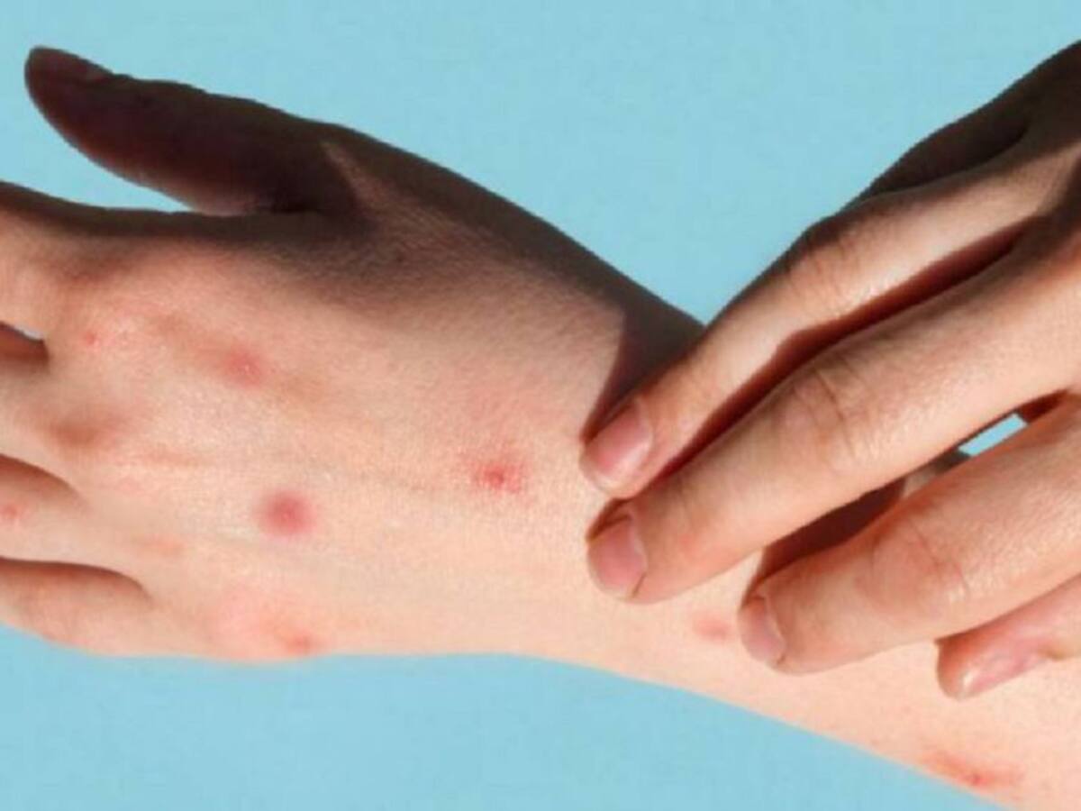 Quindío con dos casos confirmados de la viruela del mono