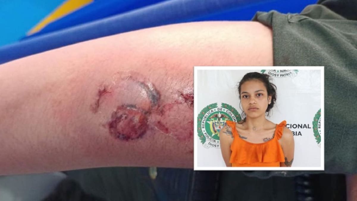 Mordida y golpeada resultó una uniformada de la Policía en Neiva