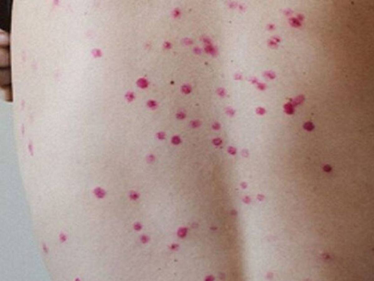 Confirman el primer caso de viruela del mono en Putumayo