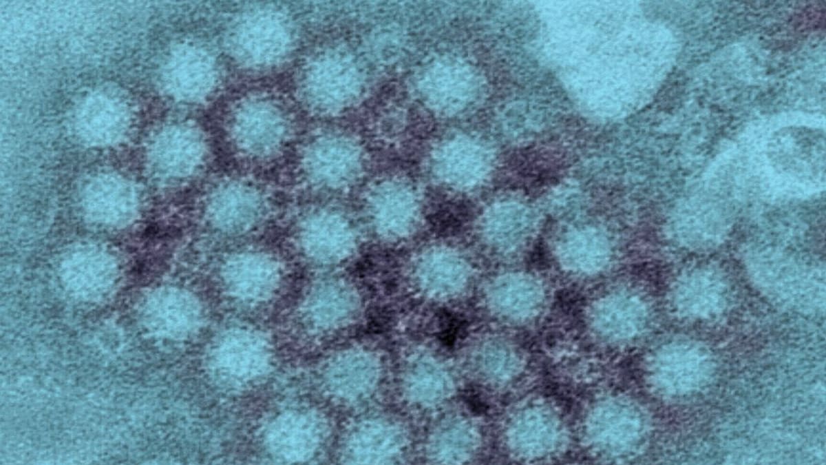 ¿Qué es el Norovirus y cuáles son sus síntomas?