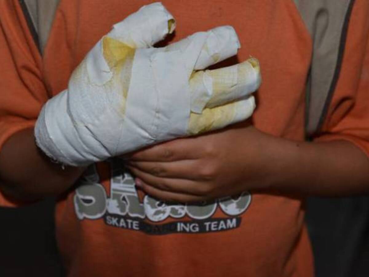 20 quemados con pólvora se reportaron en el Quindío