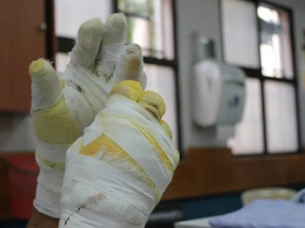 Siete quemados con pólvora en Navidad en Antioquia, incluidos dos menores de edad