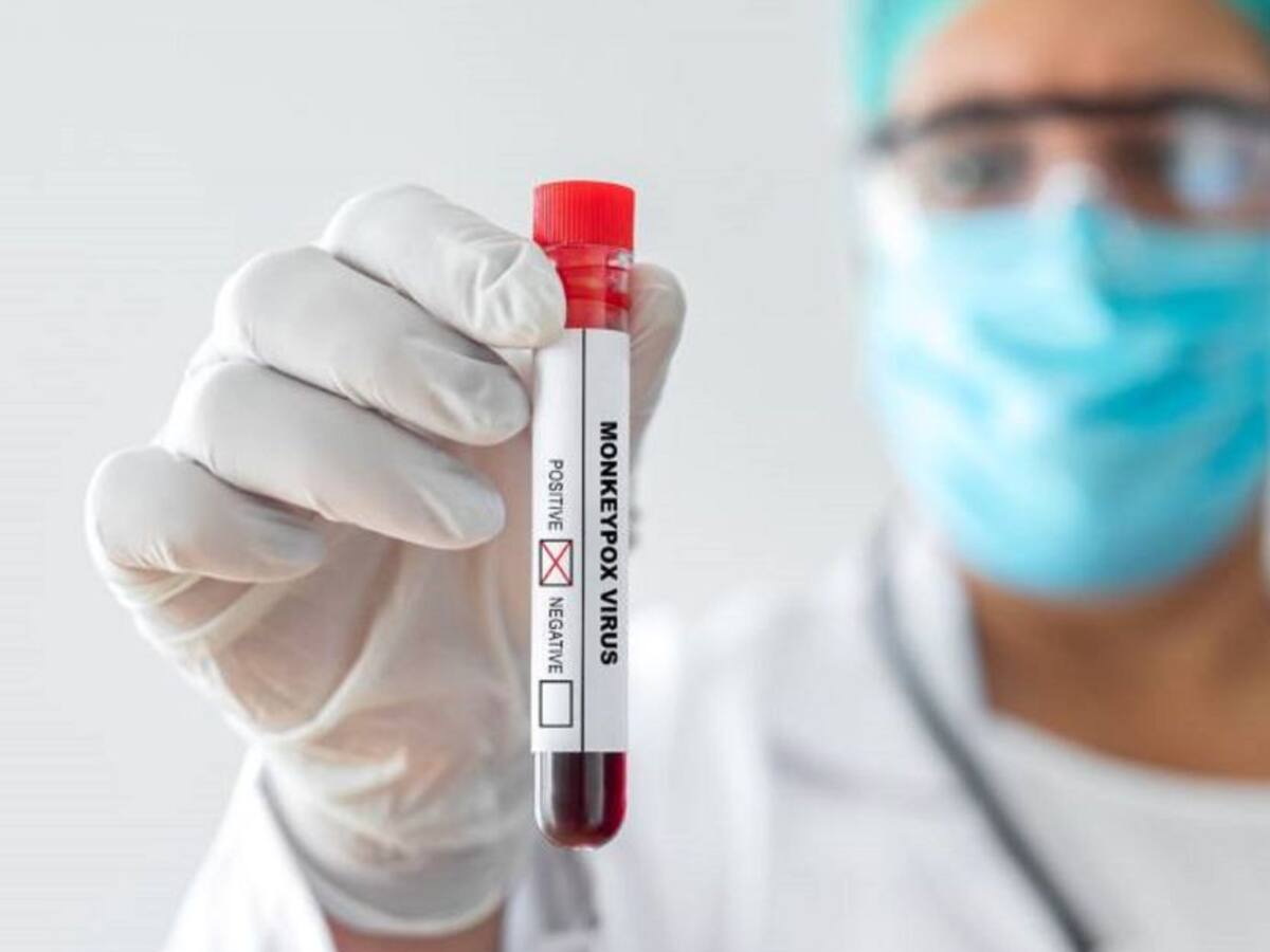 En Quindío realizan búsqueda activa por viruela del mono en el país