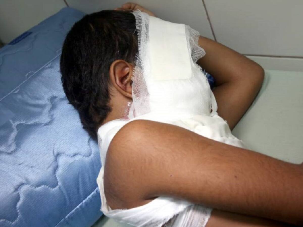 A cuatro se eleva número de quemados en la región
