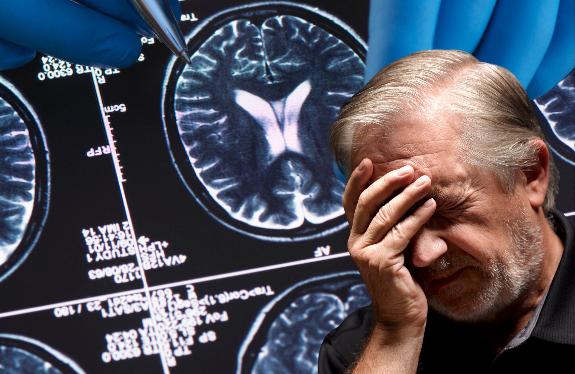 Imágenes de referencia de Alzheimer. Fotos: Getty Images