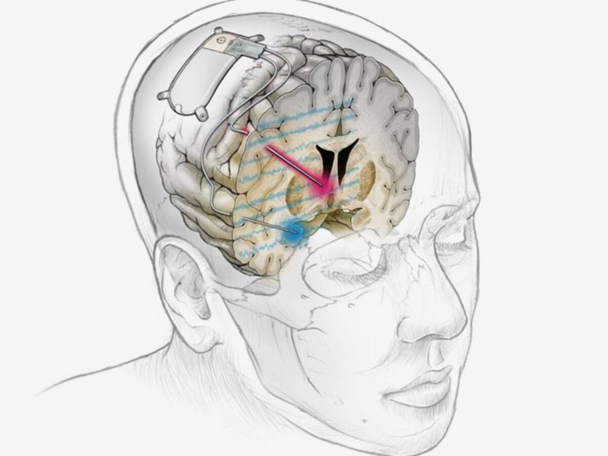 Desarrollan dispositivo cerebral para tratar la depresión