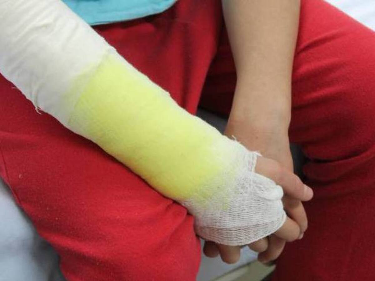 Un menor de 10 años, es el quinto quemado por manipulación de pólvora en Caldas