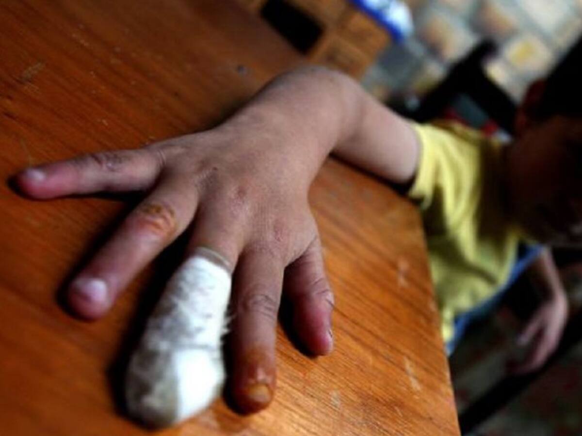 ICBF lanzó la campaña para evitar niños quemados con pólvora