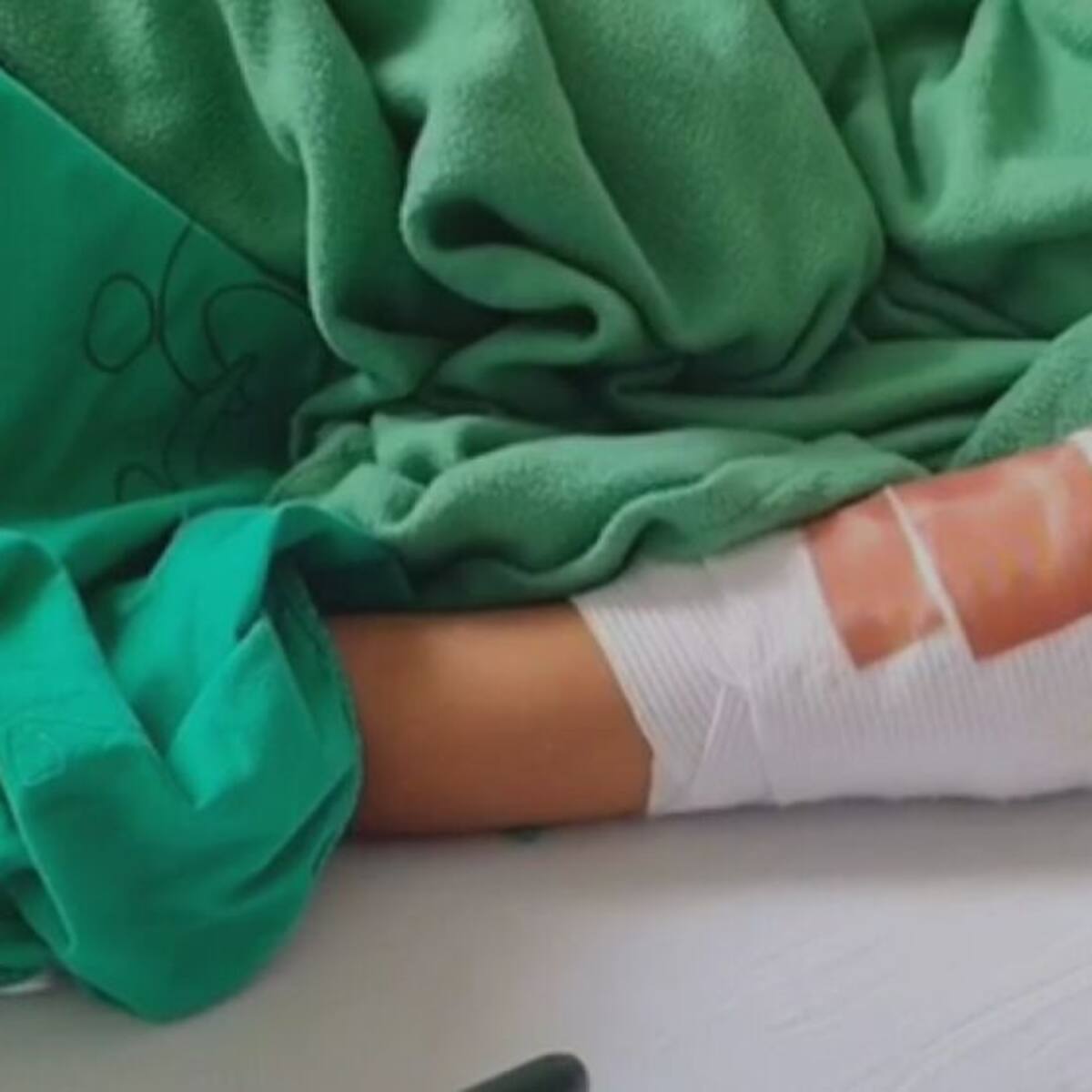 Trasladarán a Barranquilla a menor que fue quemada con ácido en el departamento de Sucre