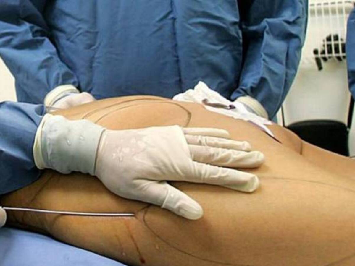 Murió mujer luego de aplicarse biopolímeros en los glúteos