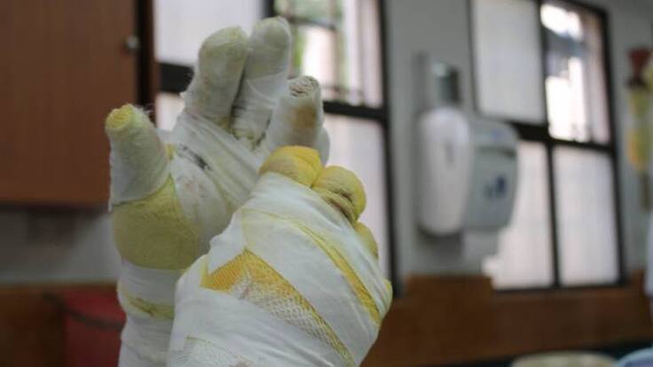 Icbf anuncia sanciones para padres de familia de dos niños que ya resultaron quemados con pólvora