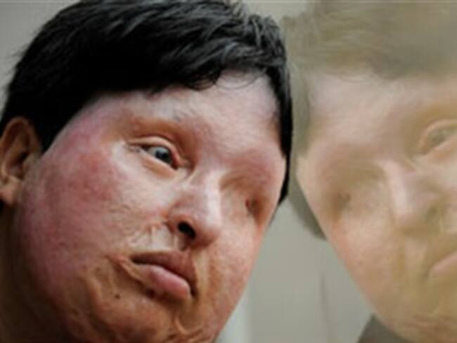 Iraní ciega tras ser atacada con ácido renuncia a la ley del talión