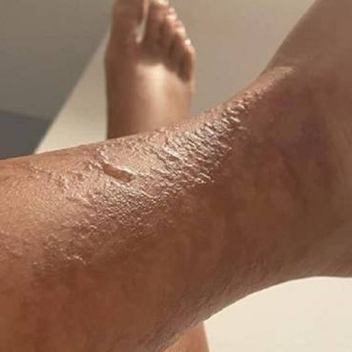 Piden cerrar Clínica Estética de Manizales por tener heridas en el cuerpo