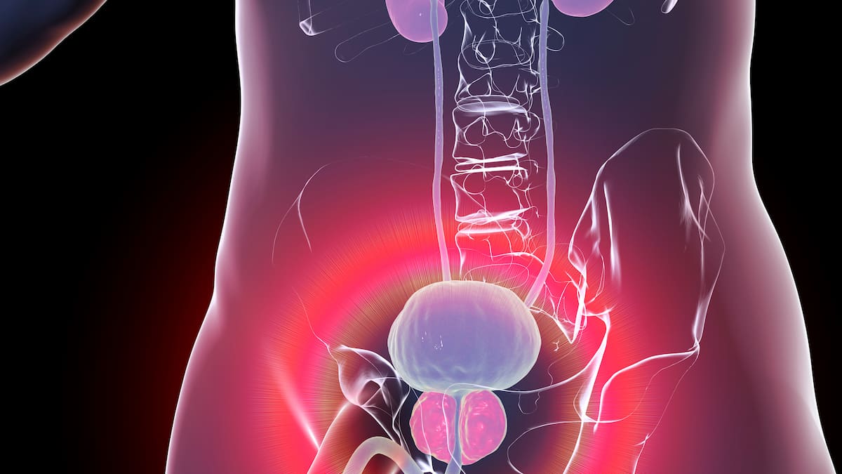 Prevención y tratamientos personalizados: las claves para enfrentar el cáncer de próstata