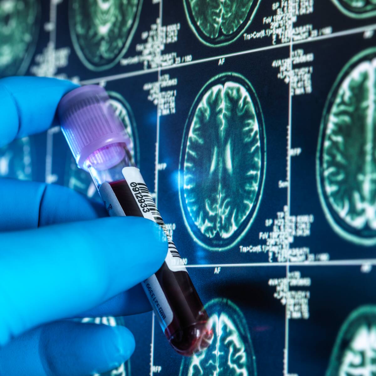 Medicamento podría retrasar la aparición del Alzheimer: así funciona