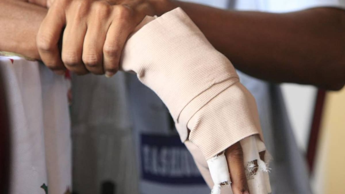 Adulto mayor perdió un dedo de su mano por manipular un volador