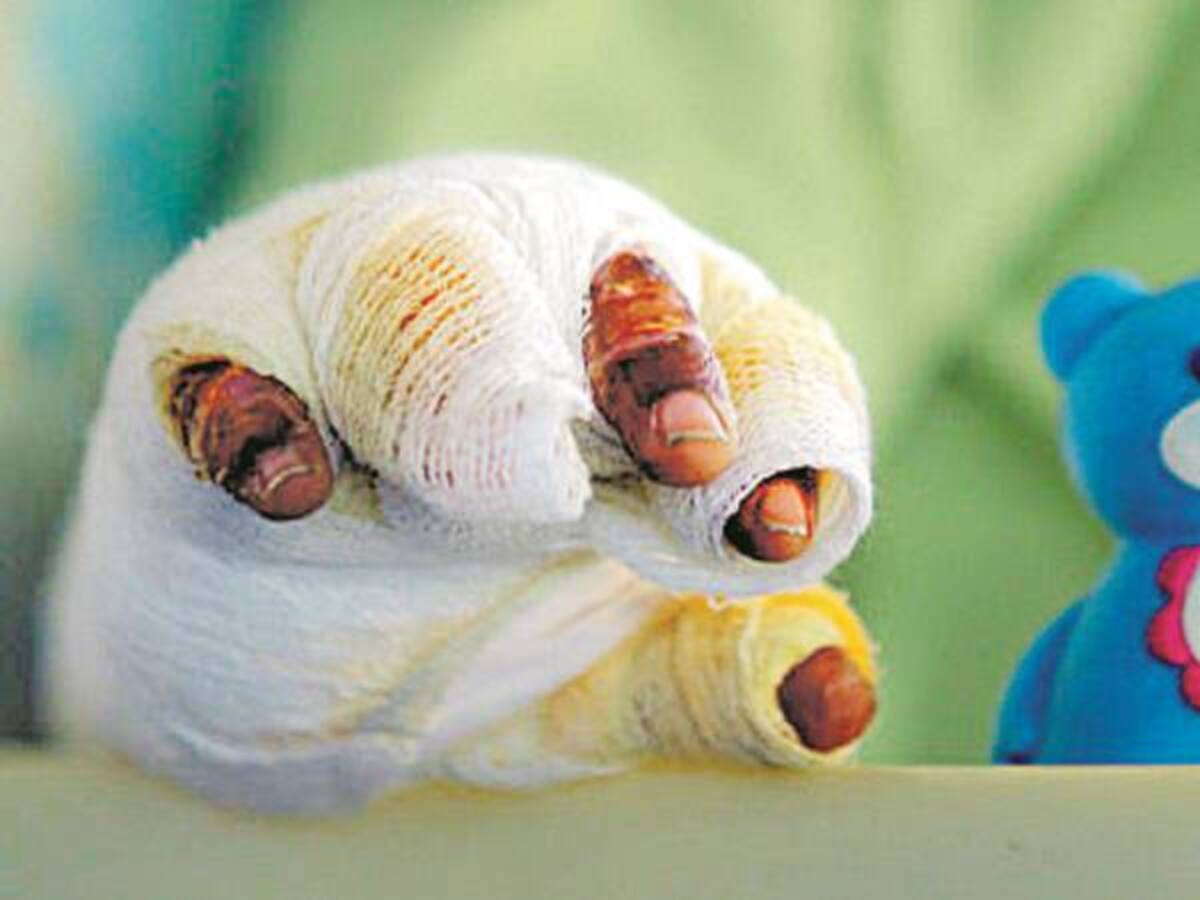 Asciende a ocho el número de personas quemadas en Bogotá