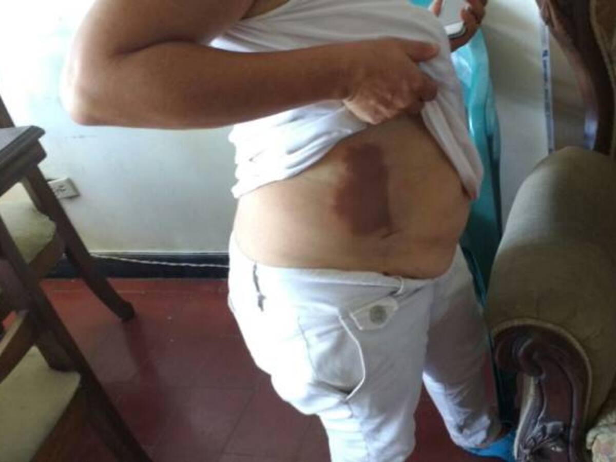 Mujer denuncia ataque con ácido en Barranquilla