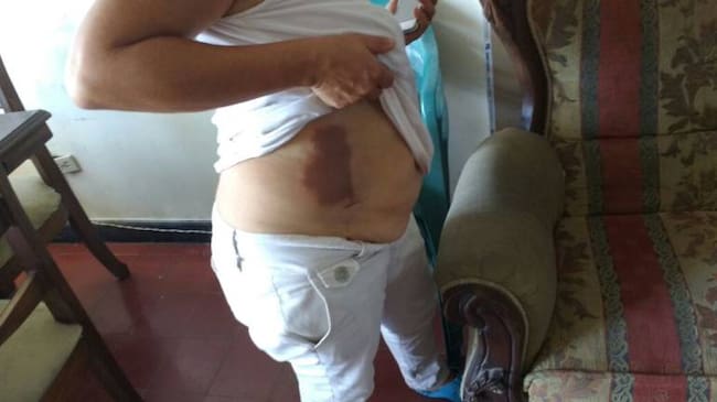 Mujer atacada con una sustancia química