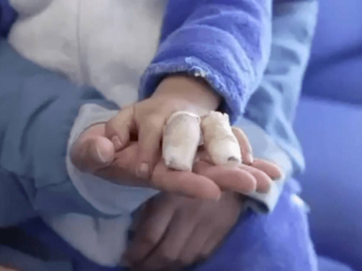 Aumentan los casos de personas quemadas con pólvora en Boyacá: ya son 28 los lesionados