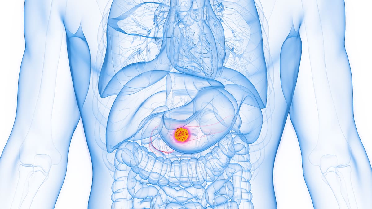 Así funciona fármaco ‘experimental’ que duplicaría supervivencia de pacientes con cáncer de páncreas