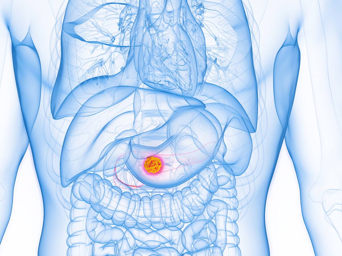 Así funciona fármaco ‘experimental’ que duplicaría supervivencia de pacientes con cáncer de páncreas