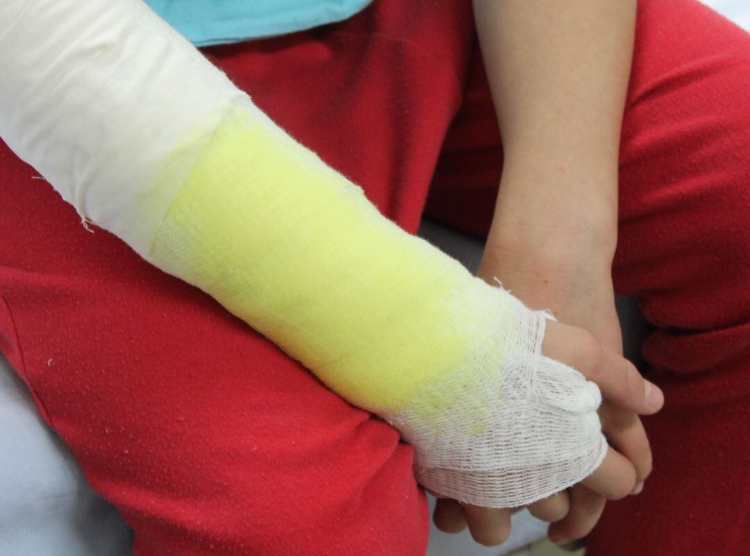 Quemado con pólvora