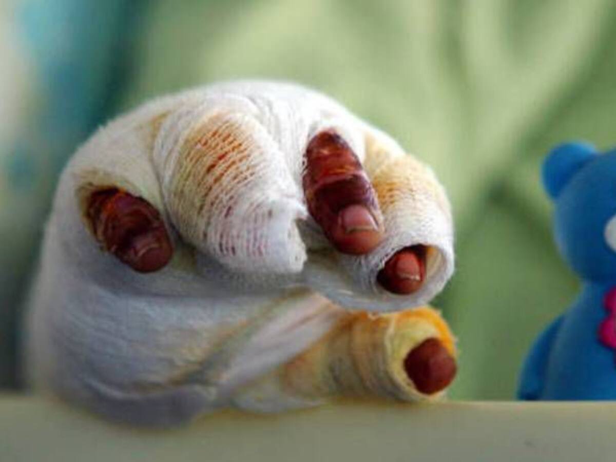 En Armenia NO se presentaron quemados con pólvora en celebración de navidad