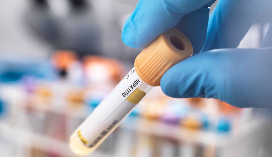 Revisión de pruebas de hepatitis.                       Foto: Getty