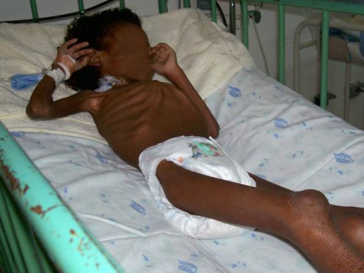 Aumenta a 92 la cifra de menores muertos por desnutrición en 2016