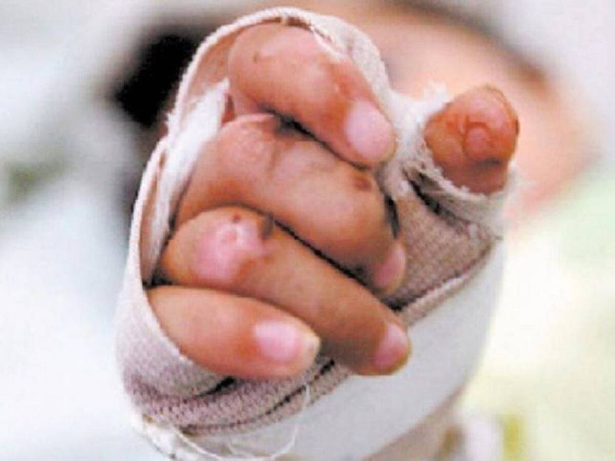 345 niños en Antioquia resultaron quemados con líquidos calientes