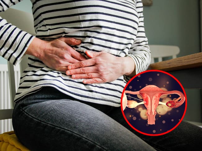 Cáncer de ovario, imagen de referencia // fotos: Getty Images