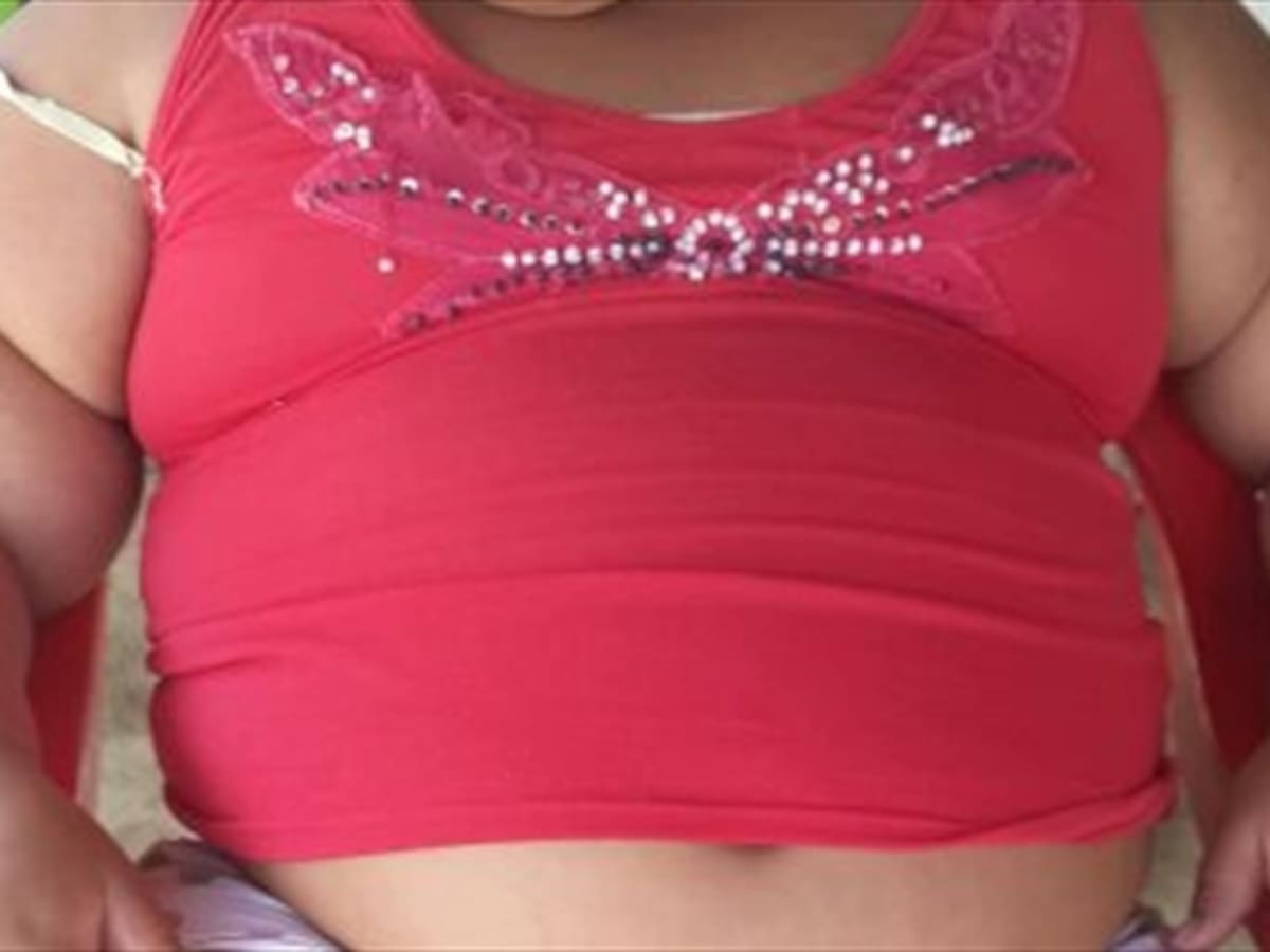 Rescatan en Guaranda, Sucre, a la niña más obesa del país y Latinoamérica