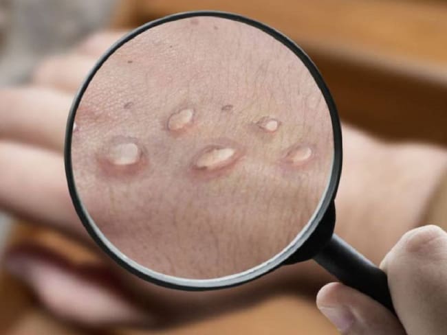 Cualquier persona con vesículas en su piel, acuda rápidamente a los organismos de salud