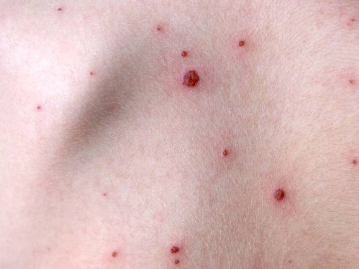 En Bogotá se han reportado 41 casos de viruela del mono