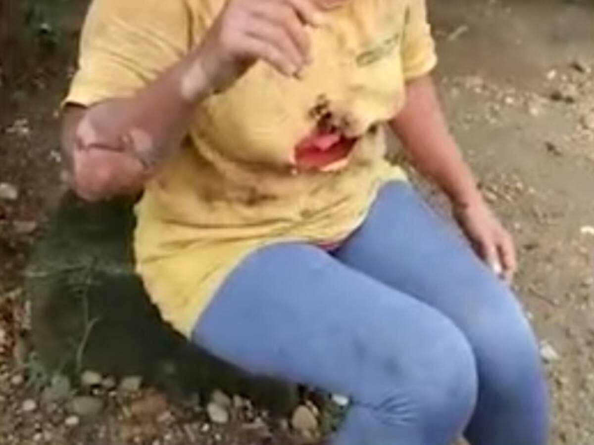 Una mujer resultó con quemaduras al explotar un pozo de agua