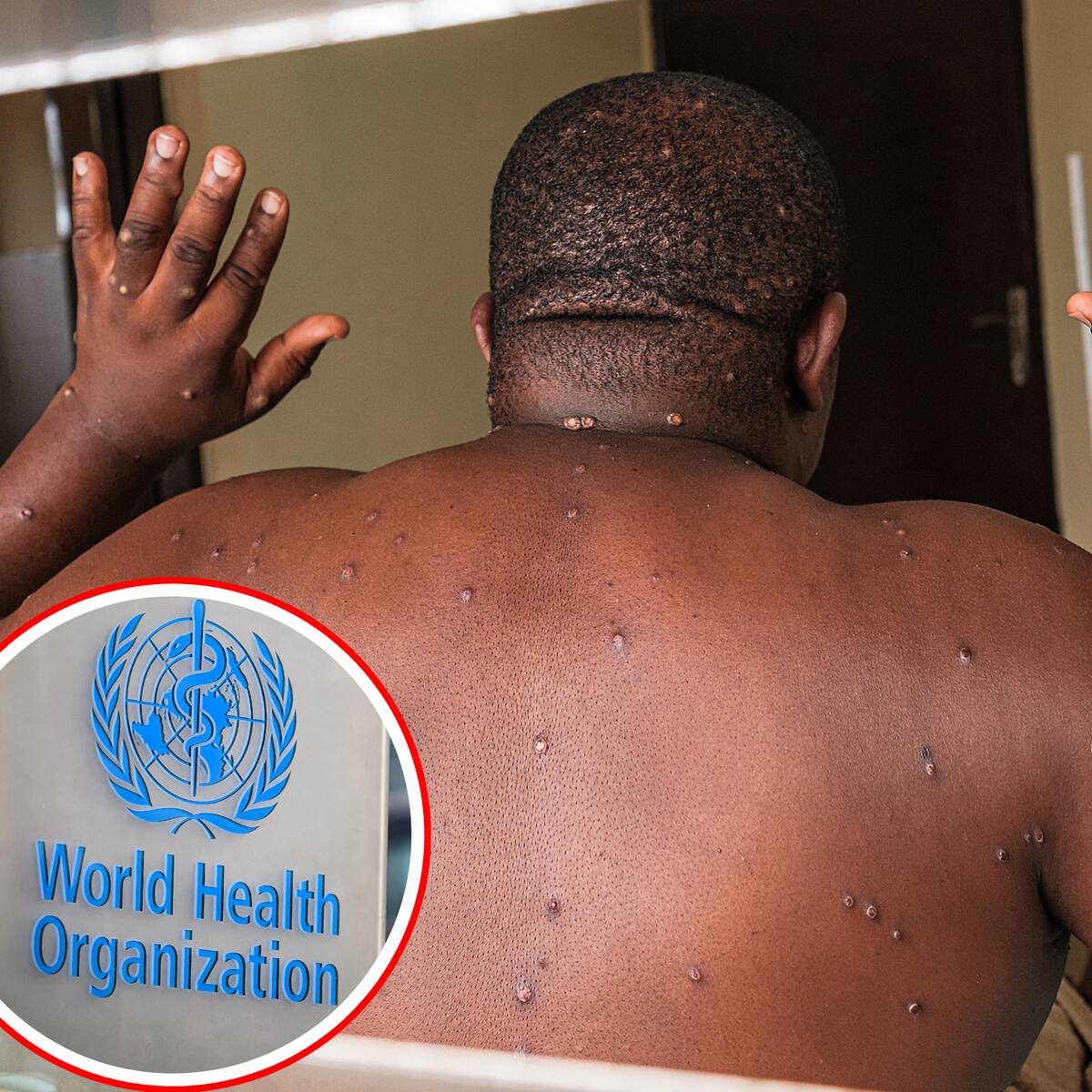 Mpox: los mitos y conspiraciones sobre la enfermedad que ya está en 3 continentes