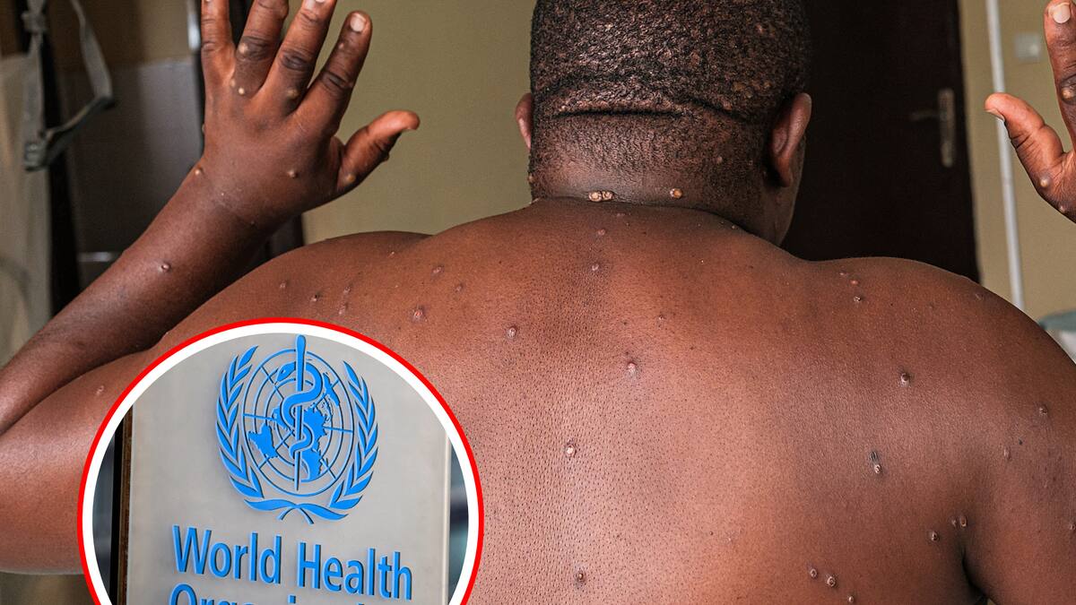 Mpox: los mitos y conspiraciones sobre la enfermedad que ya está en 3 continentes