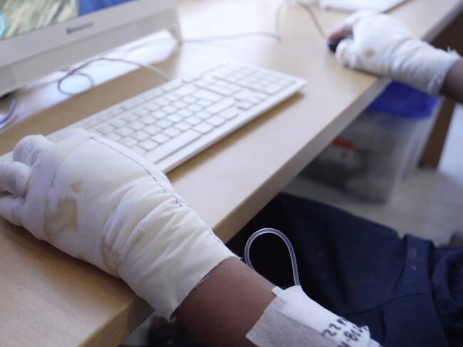 Aumenta en más de un 30% el número de personas quemadas en Bogotá