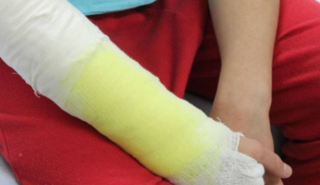 quemadura por pólvora/Imagen de referencia