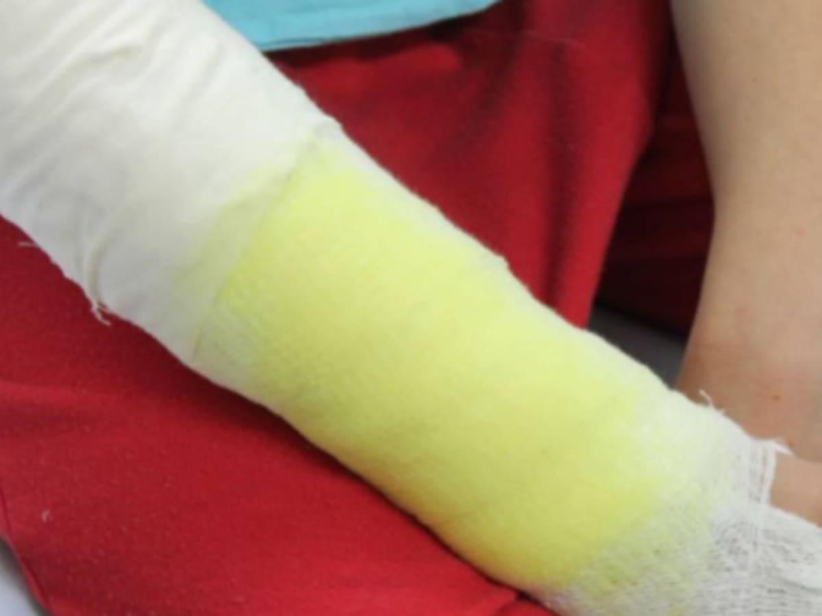 Preocupante incremento de quemados con pólvora en el Tolima