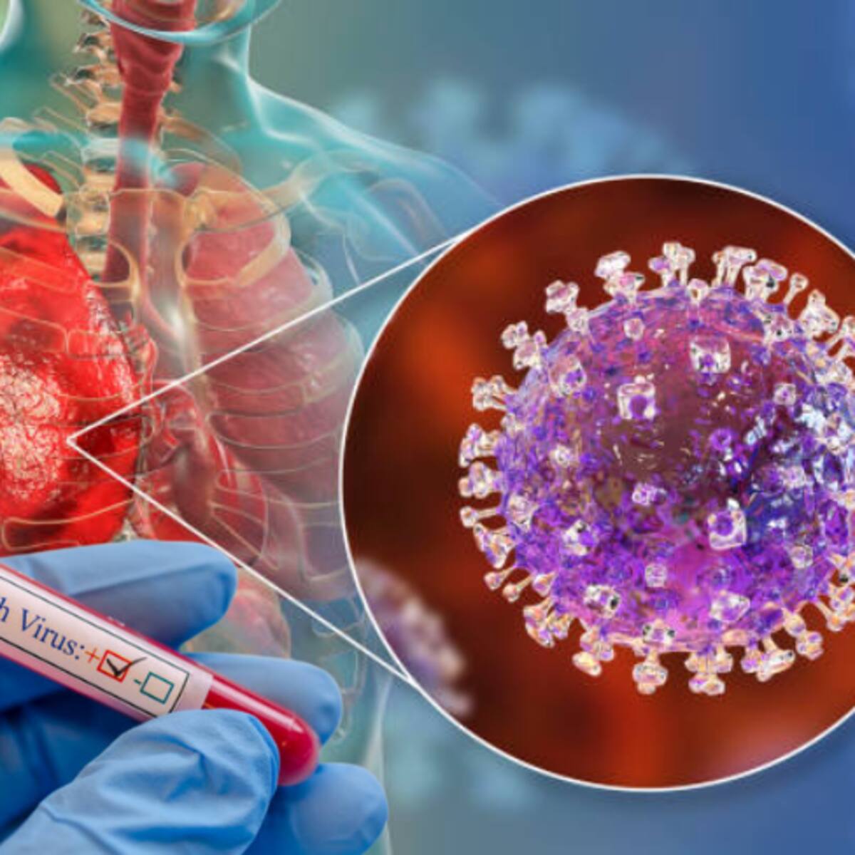 Alarma mundial por el virus Nipah: expertos descartan riesgo inmediato para Colombia